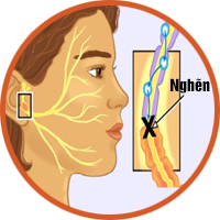 Liệt dây thần kinh số VII ngoại biên
